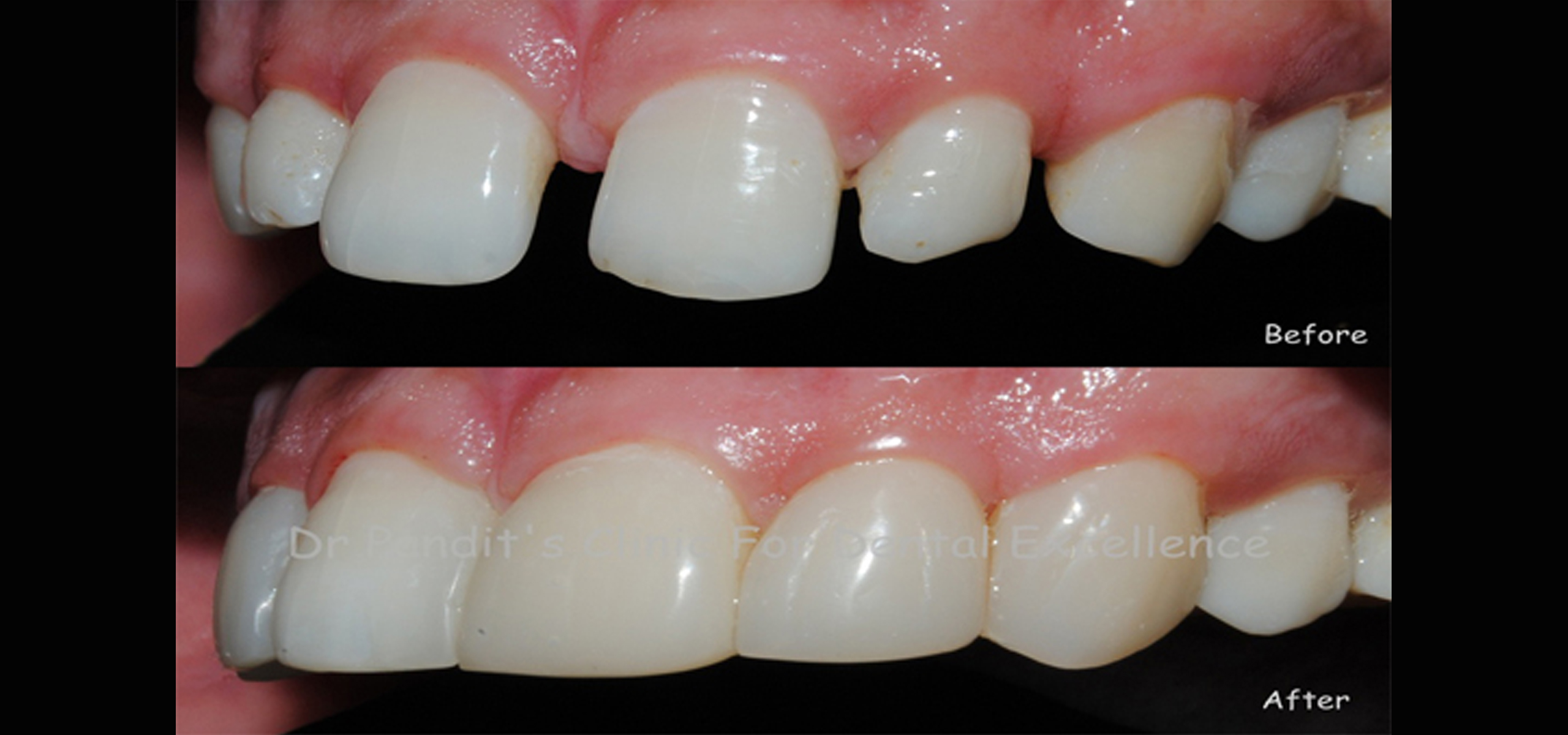 cavity filling
