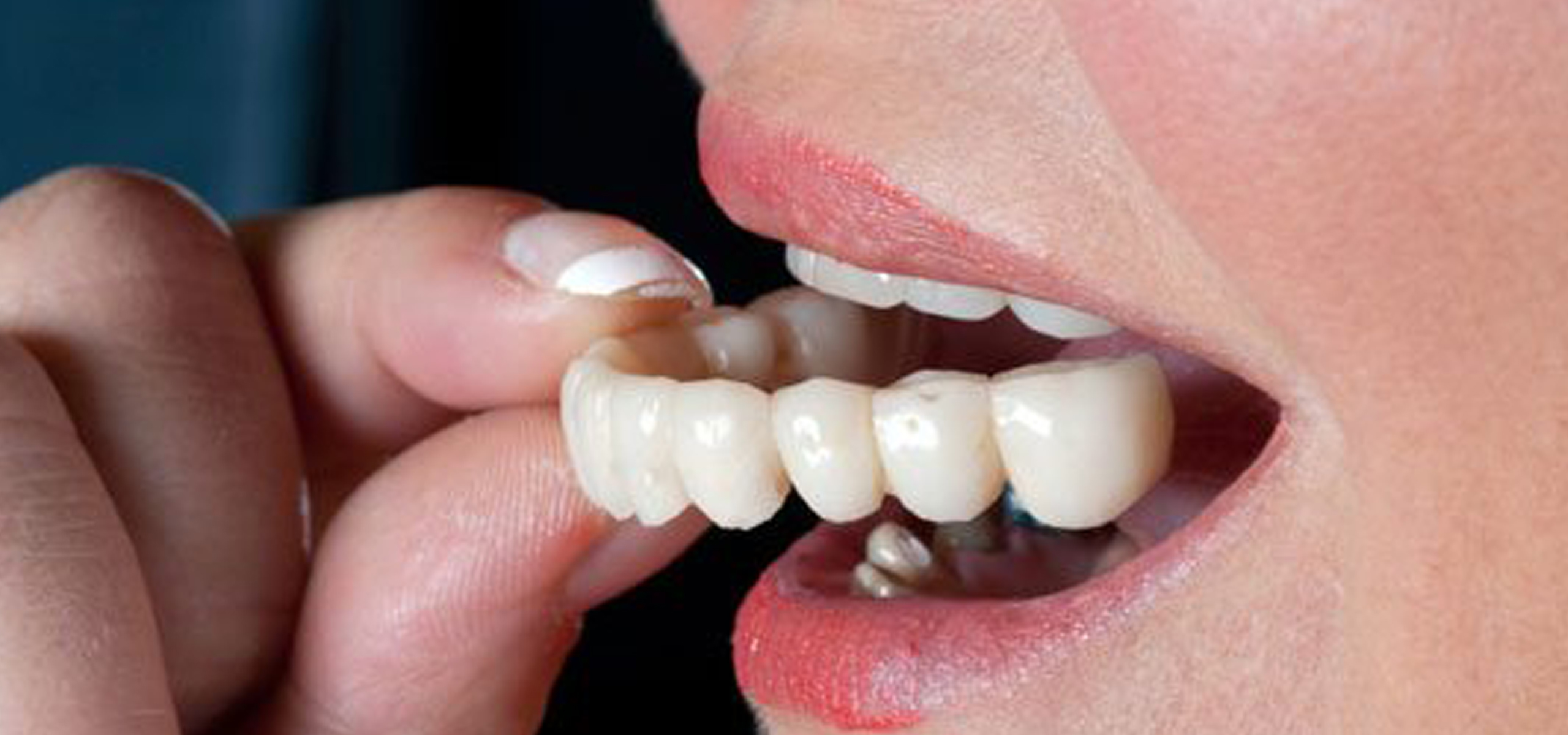 dental crown