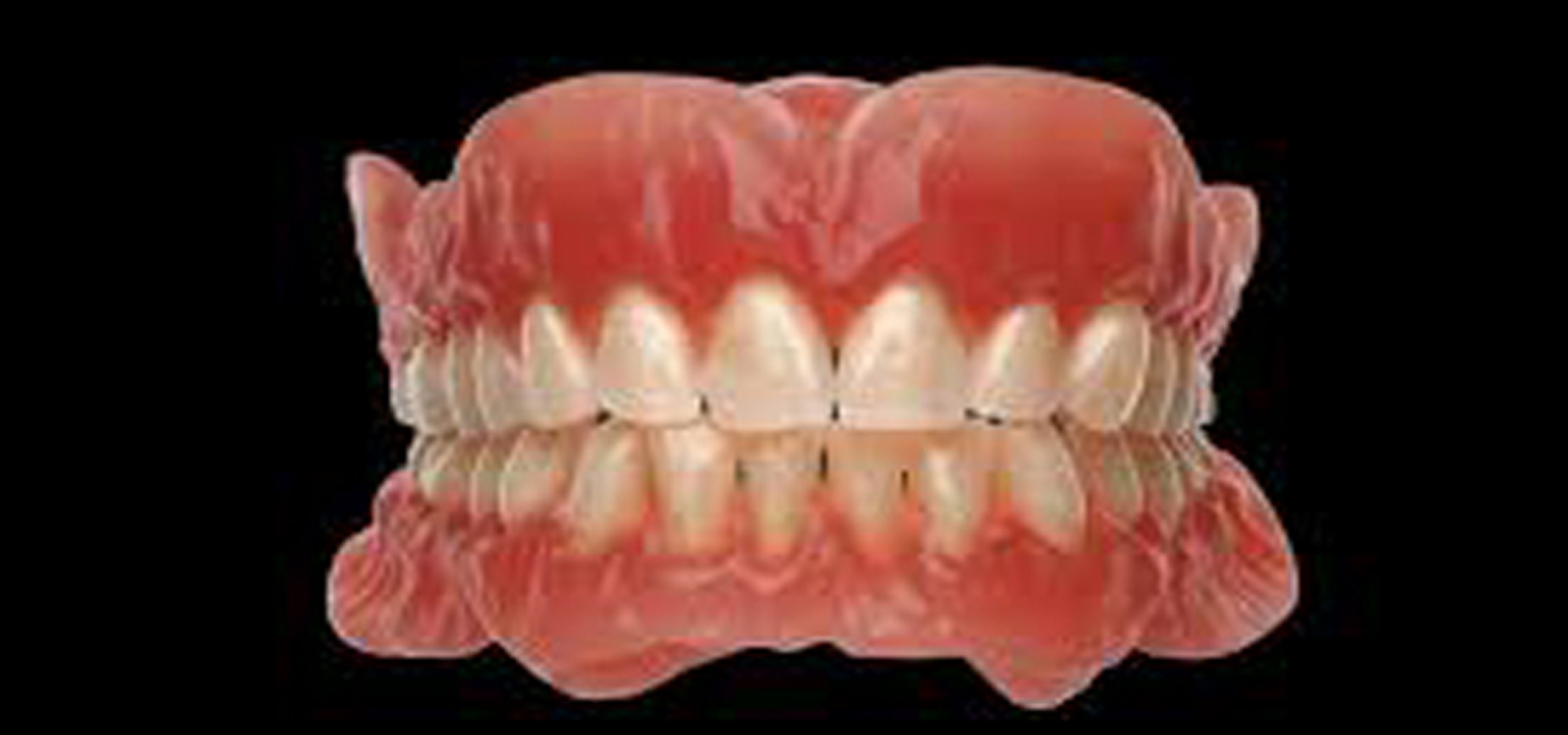 permanent dentures
