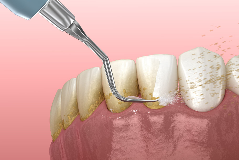 deep cleaning teeth cost
